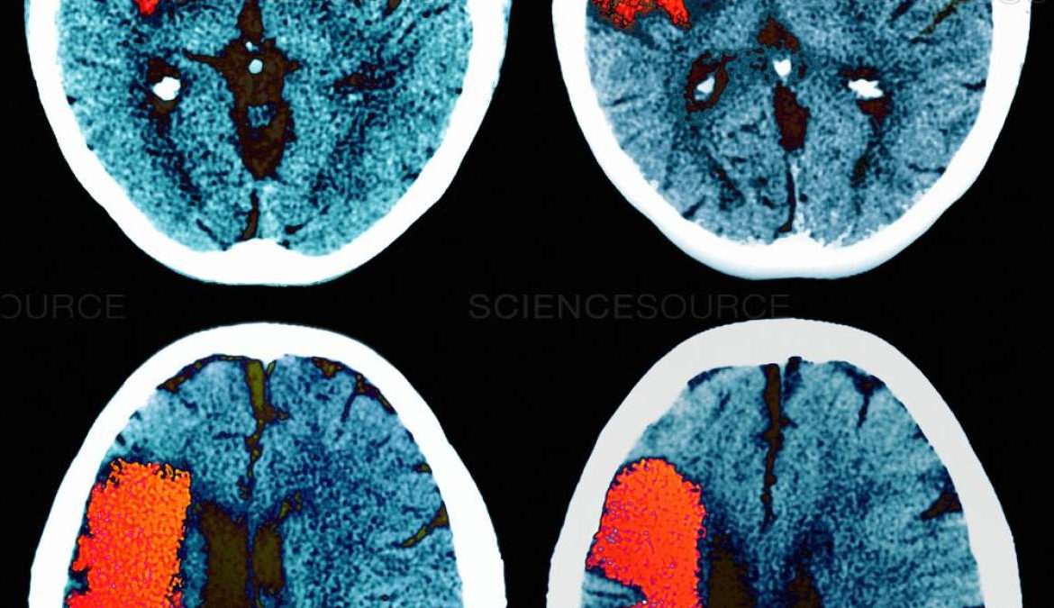 Đột quỵ và mất trí nhớ: chiến đấu với sự mất mát chức năng trong các mạch máu não nhỏ